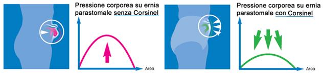 Come lavora la fasciatura per stomia corsinel